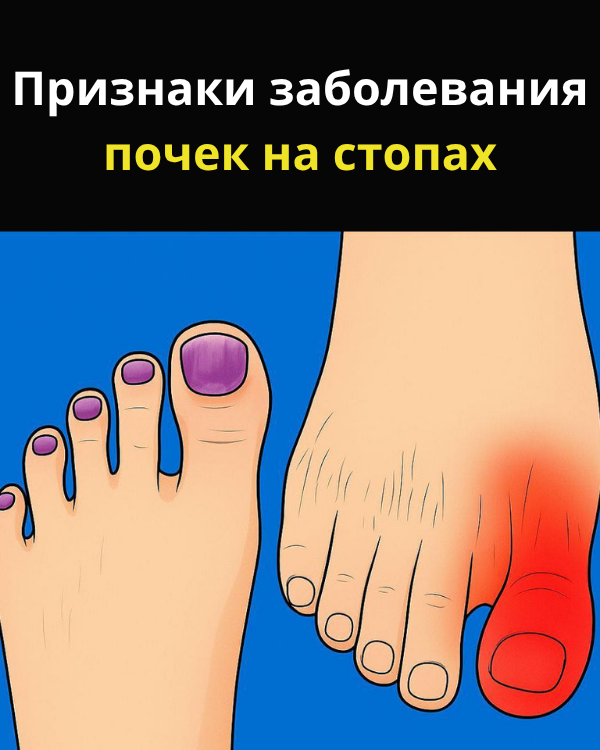 Почки выполняют жизненно важные функции: фильтруют токсины, регулируют жидкость, балансируют электролиты, поддерживают кости. Когда их работа нарушается, первые сигналы можно заметить на ногах.